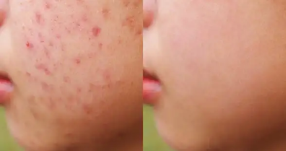 Acne and pores