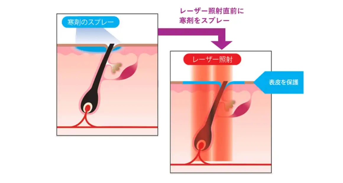 表皮冷却システム