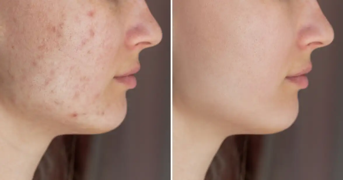 毛穴・ニキビ跡の改善