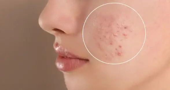 脂性肌やニキビ治療に威力を発揮し、とくに”大人ニキビ”に著効します