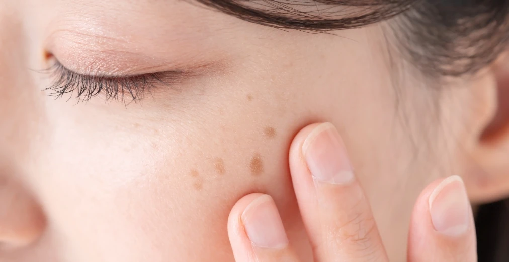 顔・体のシミ取り