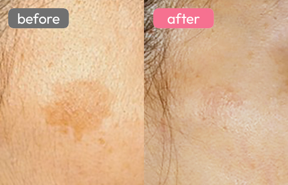 レーザートーニング