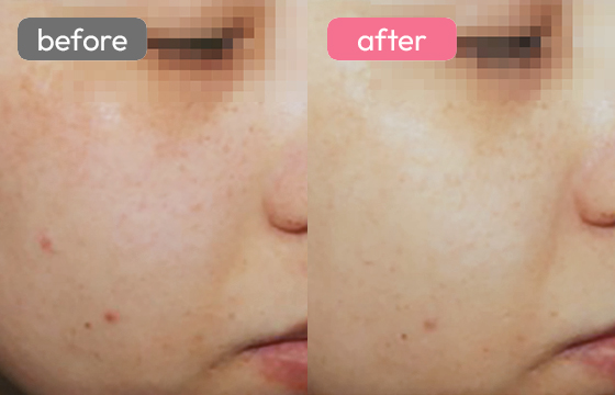 レーザートーニング