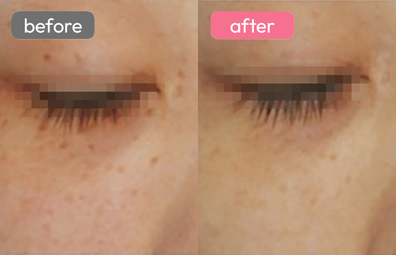 レーザートーニング