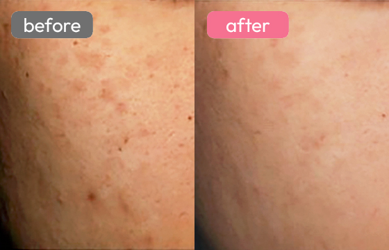 レーザートーニング