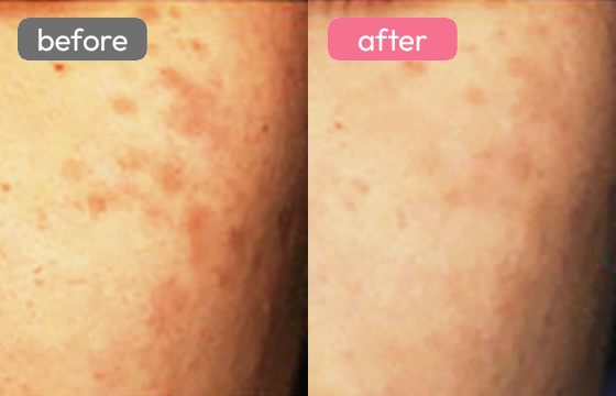 レーザートーニング