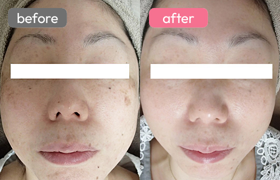 レーザートーニング