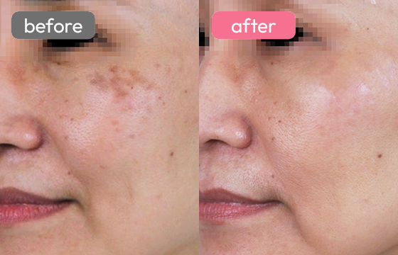 ピコスポット シミ治療