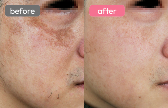 ピコスポット シミ治療