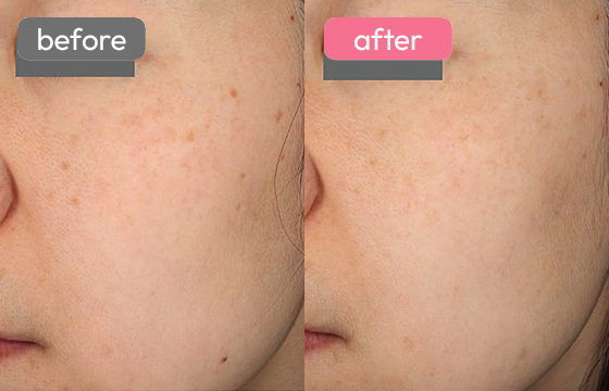 ピコスポット シミ治療