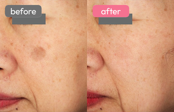 ピコスポット シミ治療