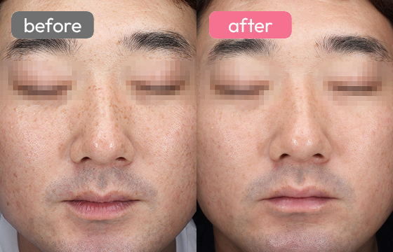 ピコトーニング