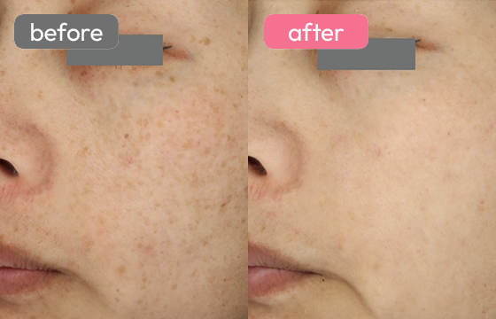 ピコスポット シミ治療