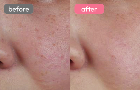 ピコレーザー ニキビ跡