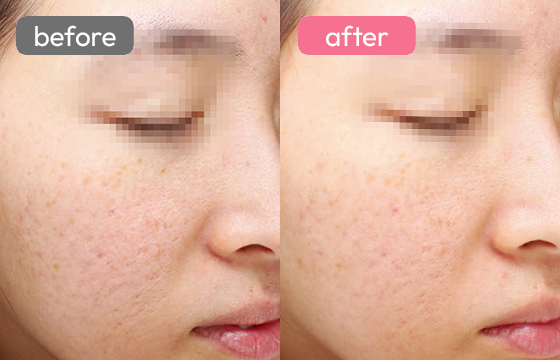 ピコレーザー ニキビ跡