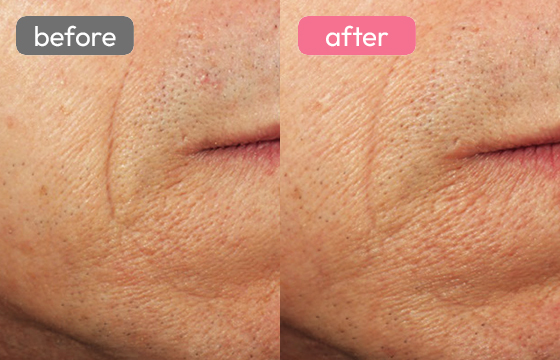 ピコレーザー シワ改善