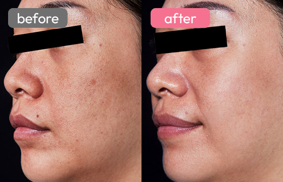 ピコスポット シミ治療