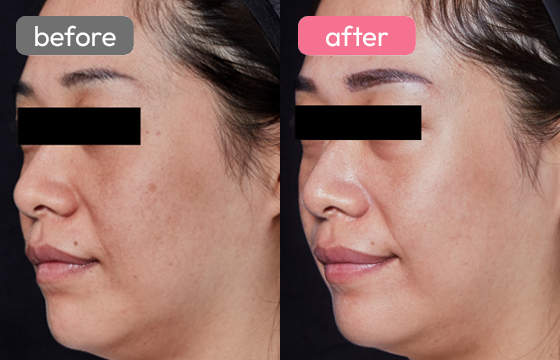 ピコスポット シミ治療