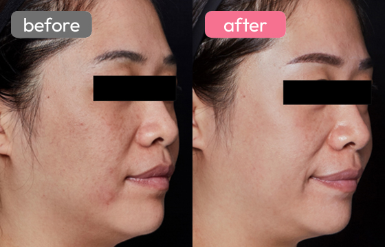 ピコスポット シミ治療