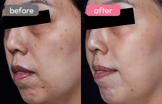 ピコスポット シミ治療