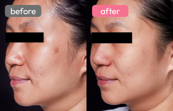 ピコスポット シミ治療