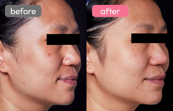 ピコスポット シミ治療