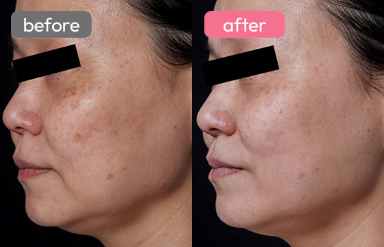 ピコスポット シミ治療