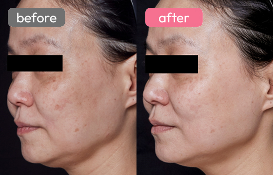 ピコスポット シミ治療