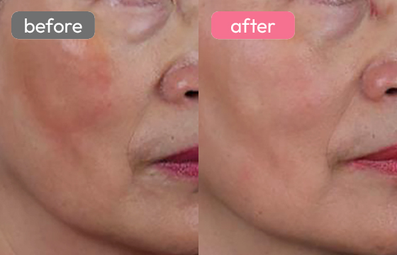 ピコトーニング