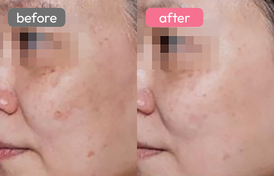 ピコスポット シミ治療