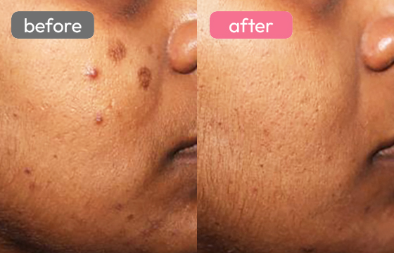 ピコスポット シミ治療