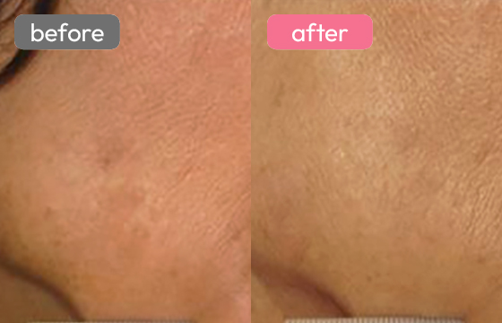 ピコトーニング