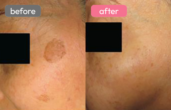 ピコスポット シミ治療