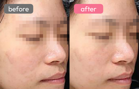 ピコトーニング