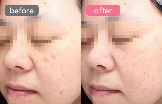 ピコ スポット シミ治療