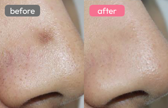 ピコスポット シミ治療