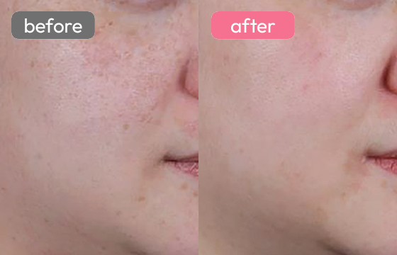 ピコスポット シミ治療