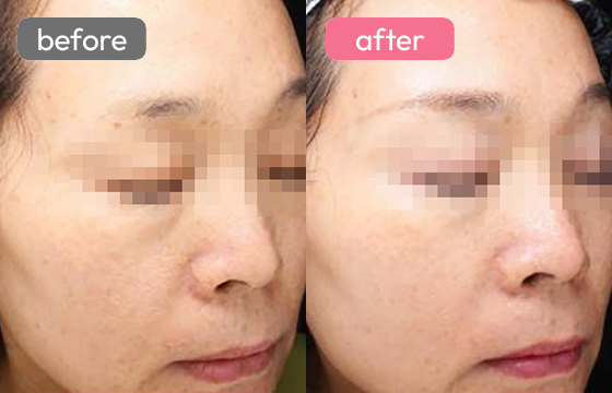 ピコトーニング