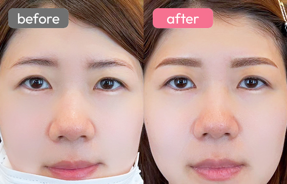 眉アートメイク-027 03