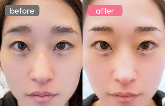 眉アートメイク-083 02