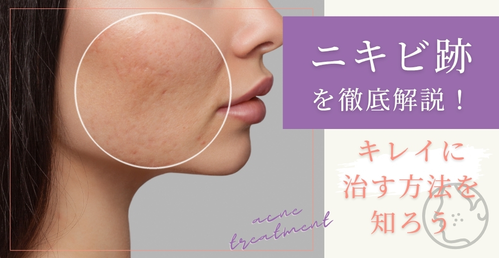 ニキビ跡を徹底解説！キレイに治す方法を知ろう