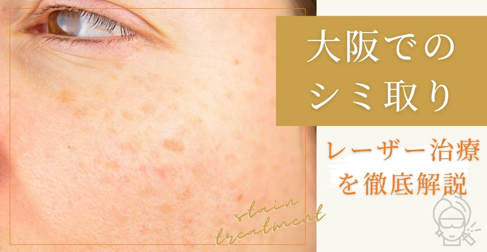 大阪でのシミ取りレーザー治療を徹底解説