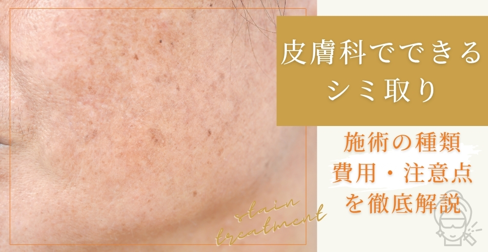 【皮膚科でできるシミ取り】施術の種類・費用・注意点を徹底解説