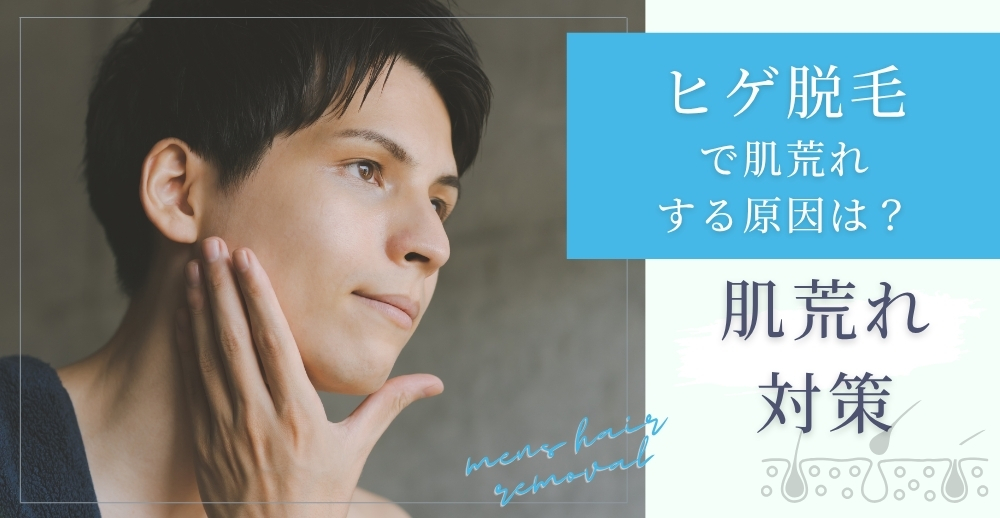 ヒゲ脱毛で肌荒れする原因は？肌荒れ対策や脱毛による肌荒れ改善効果についても解説