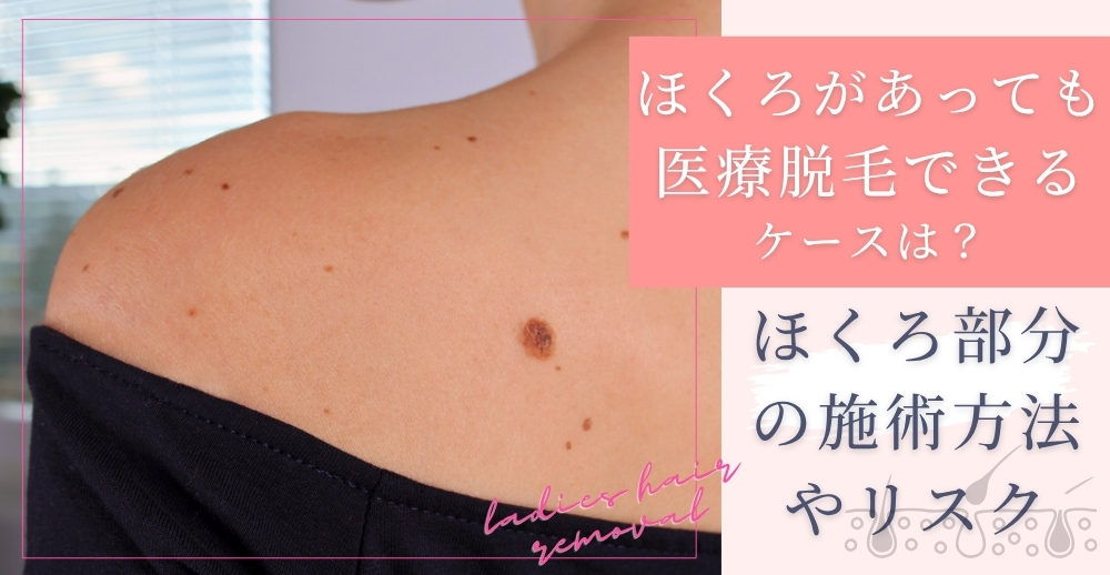 ほくろがあっても医療脱毛できるケースは？ほくろ部分の施術方法やリスクについて解説