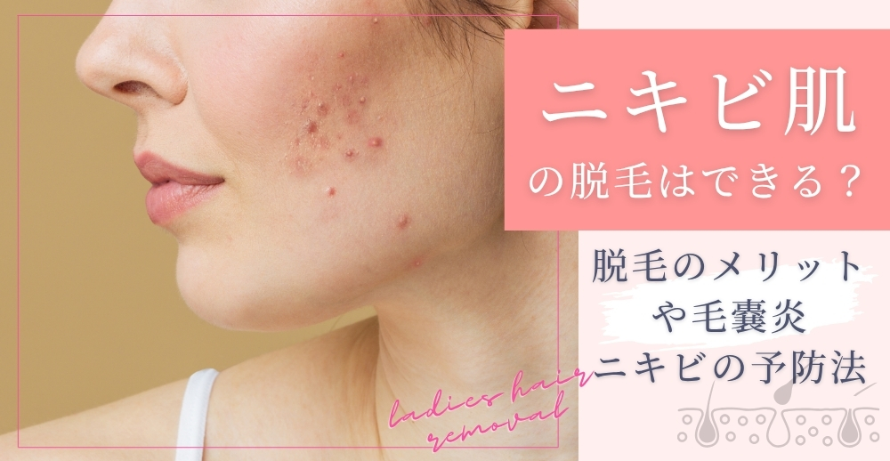 ニキビ肌への脱毛はできる？脱毛のメリットや毛嚢炎、ニキビの予防法について解説