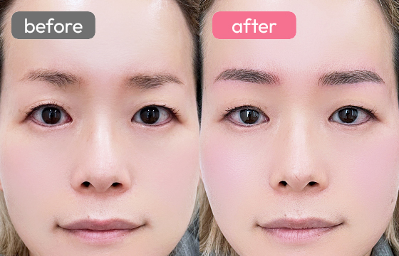 眉アートメイク-075 02