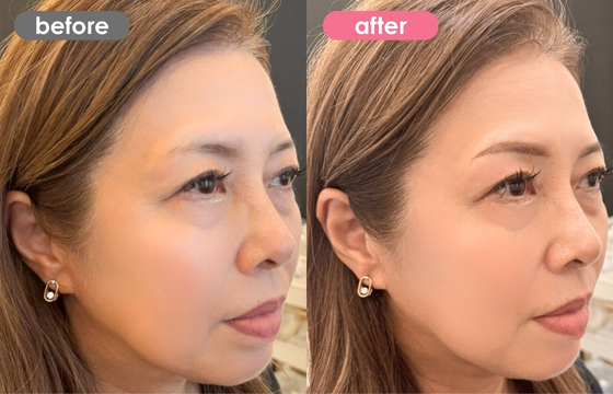 眉アートメイク-125 03