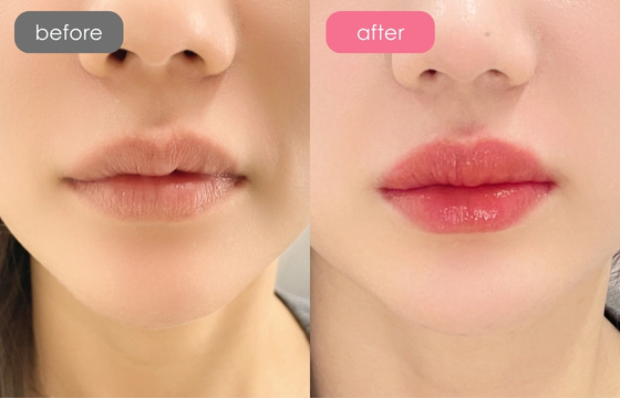 唇アートメイク-03 02