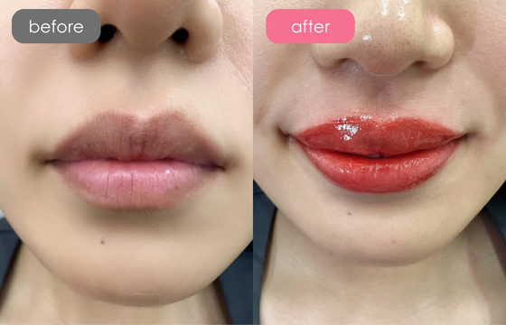 唇アートメイク-05 03
